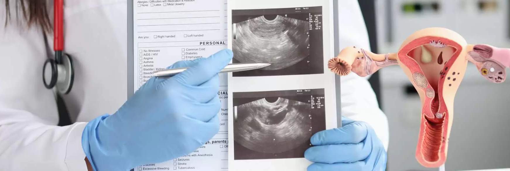 Odluka o prekidu trudnoće: Kiretaža ili prekid trudnoće uz pomoć lekova